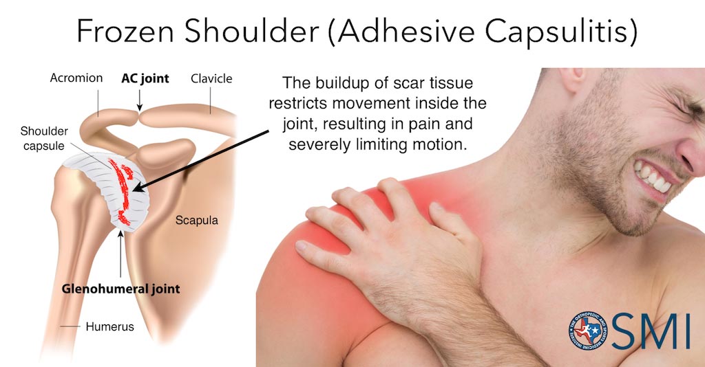 frozen-shoulder.jpg